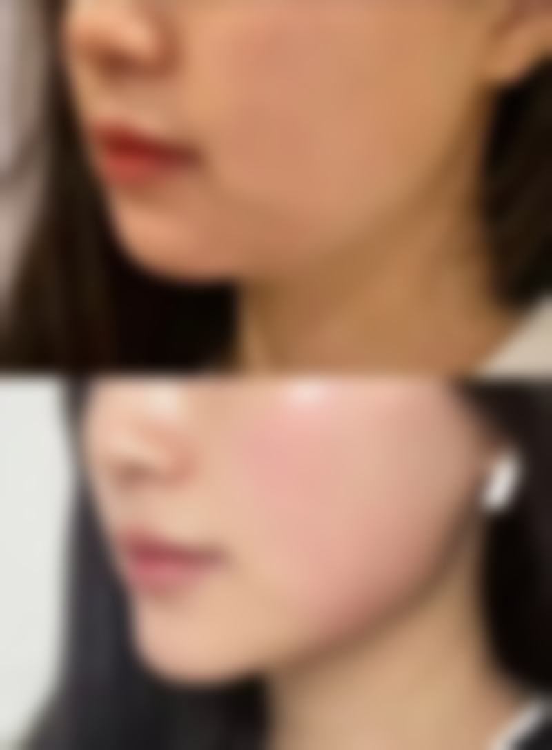 瘦脸针打完多久见效