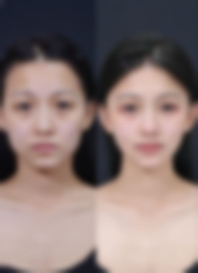 毛发种植多少天可以理发