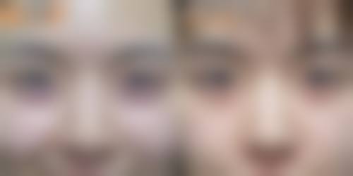 头发种植能保持多久时间
