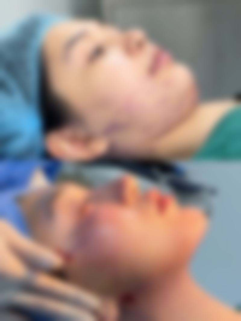 注射瘦脸针的副作用