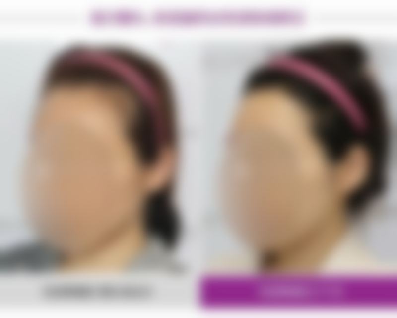 保妥适瘦脸针多少单位