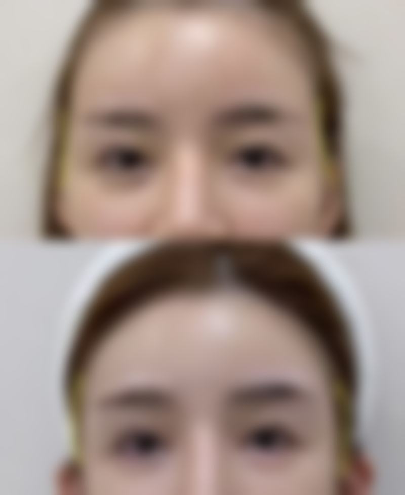 保妥适瘦脸针价格表