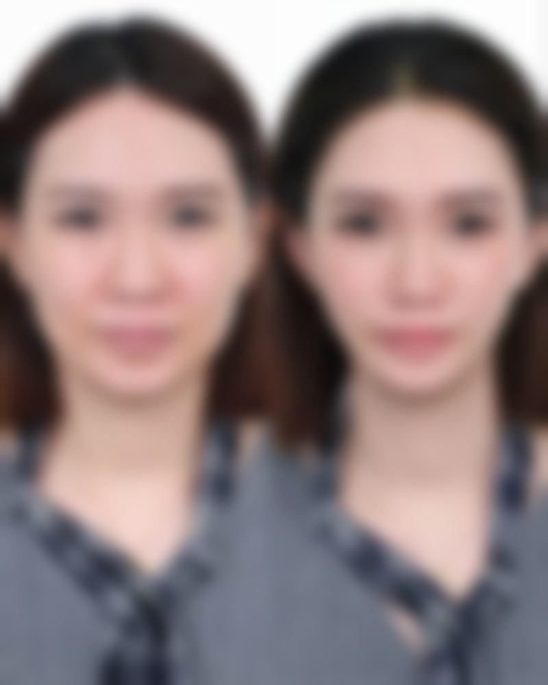 头发种植手术怎么做？了解这5大关键步骤与3大优势，让你轻松拥有浓密秀发！ 