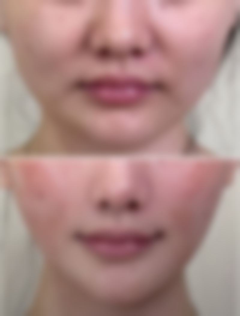 打瘦脸针有后遗症吗