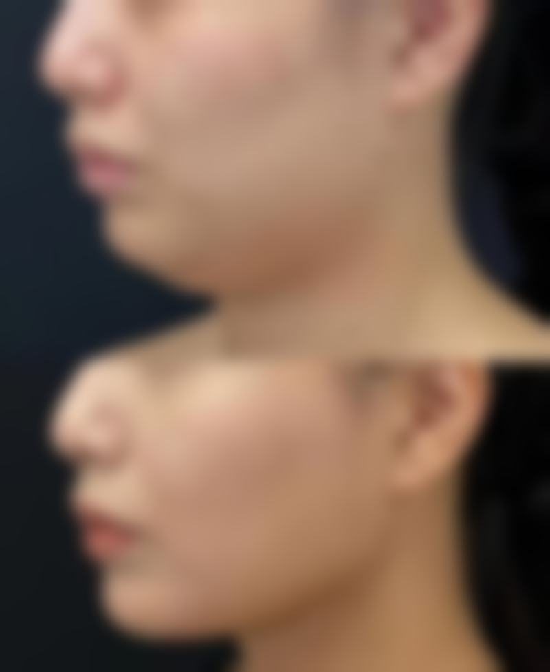三、宝宝嘴凸是骨性还是牙性的判断