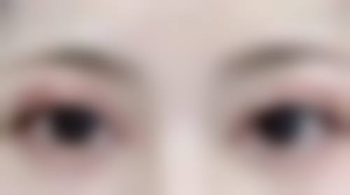 打完眼部除皱出现眼部僵硬