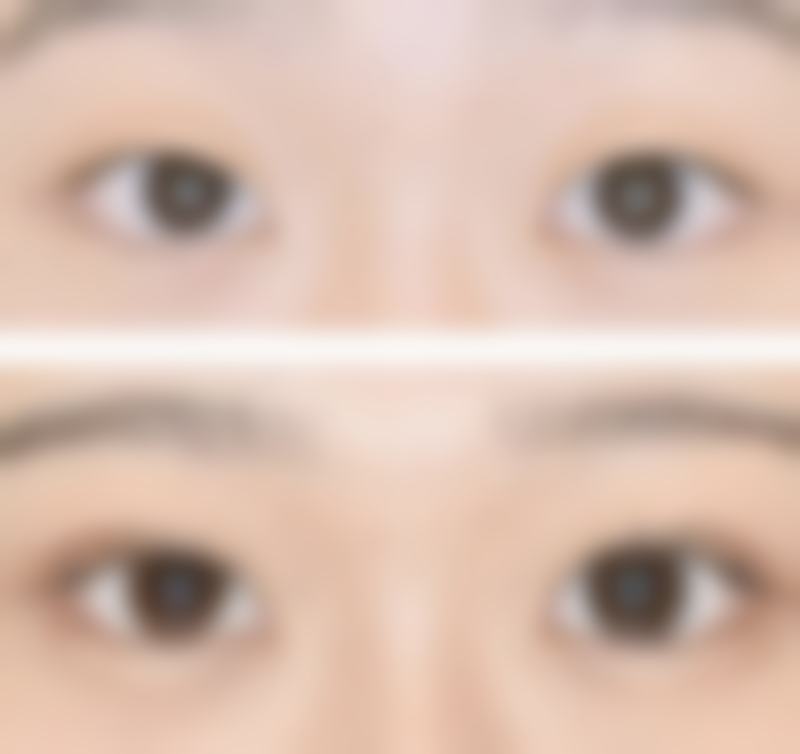 虞美人全脸除皱的注意事项