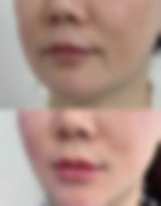 绿毒瘦脸针多久有成效