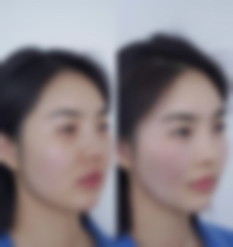 瘦脸针抗药之后多久才能重新注射