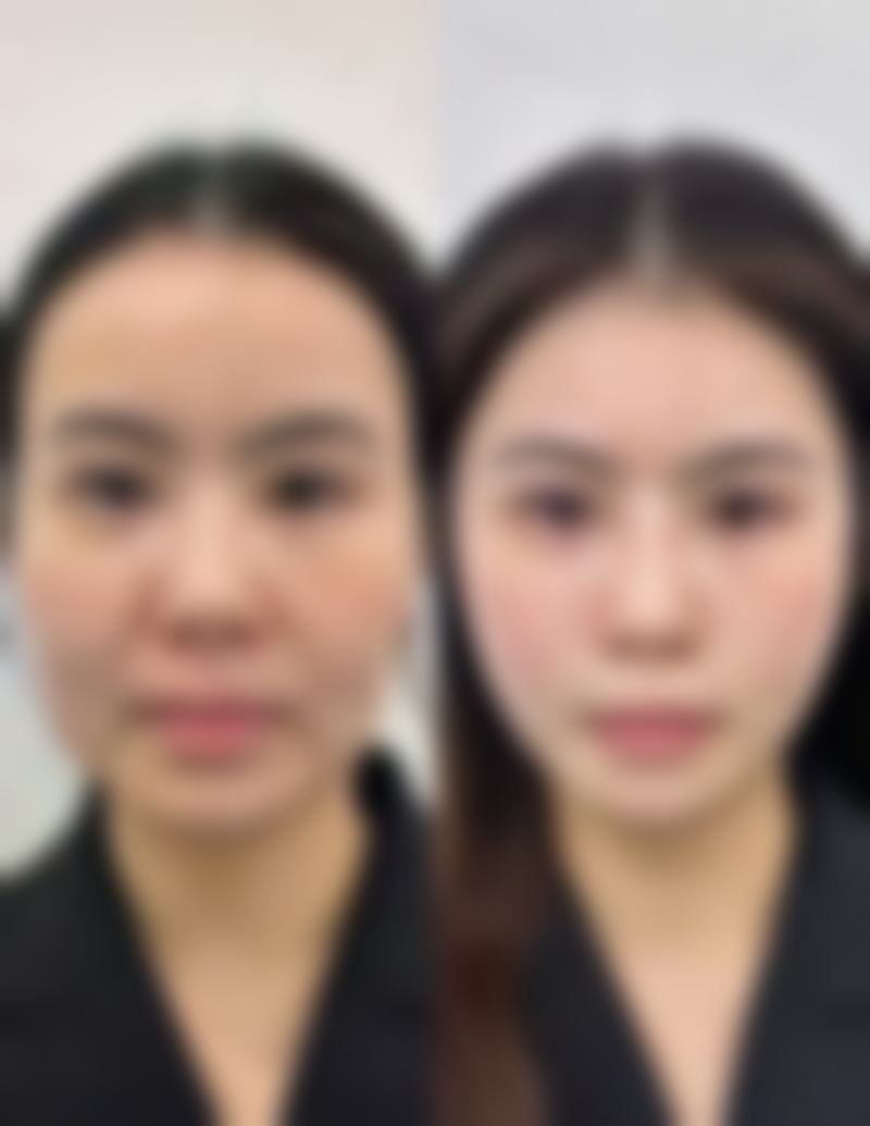 说话嘴歪可以矫正过来吗