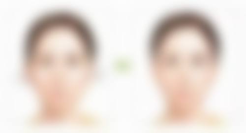 嘴角肉下垂做什么项目