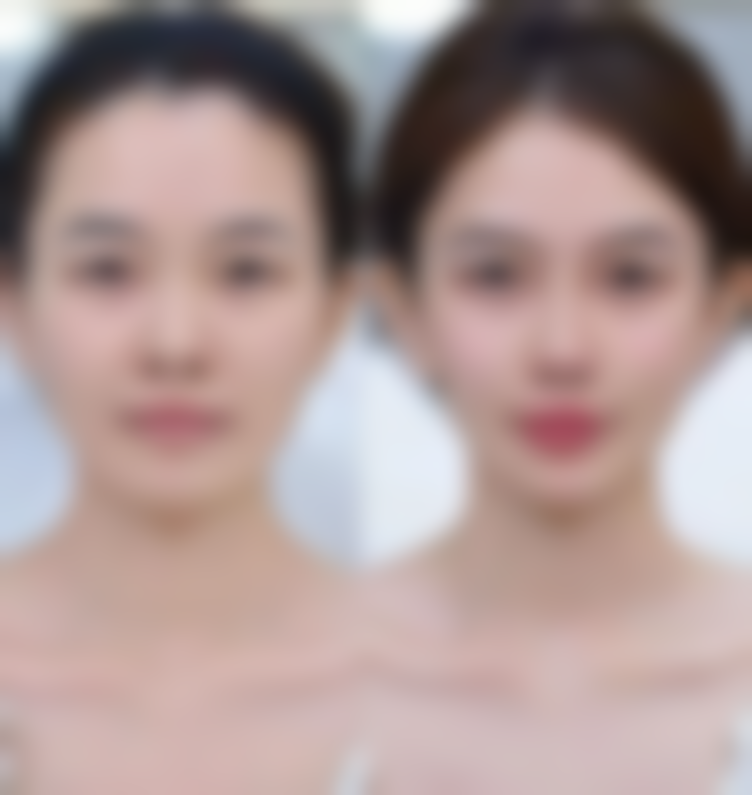 美白针可以局部美白吗？权威揭秘美白针局部美白真相，3大优势让你轻松拥有局部亮白肌肤！ 