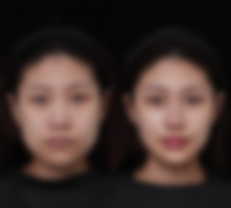 嘴唇上翘怎么办 上嘴唇翘纠正方法