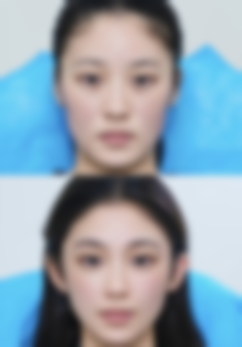 瘦脸针的起效时间