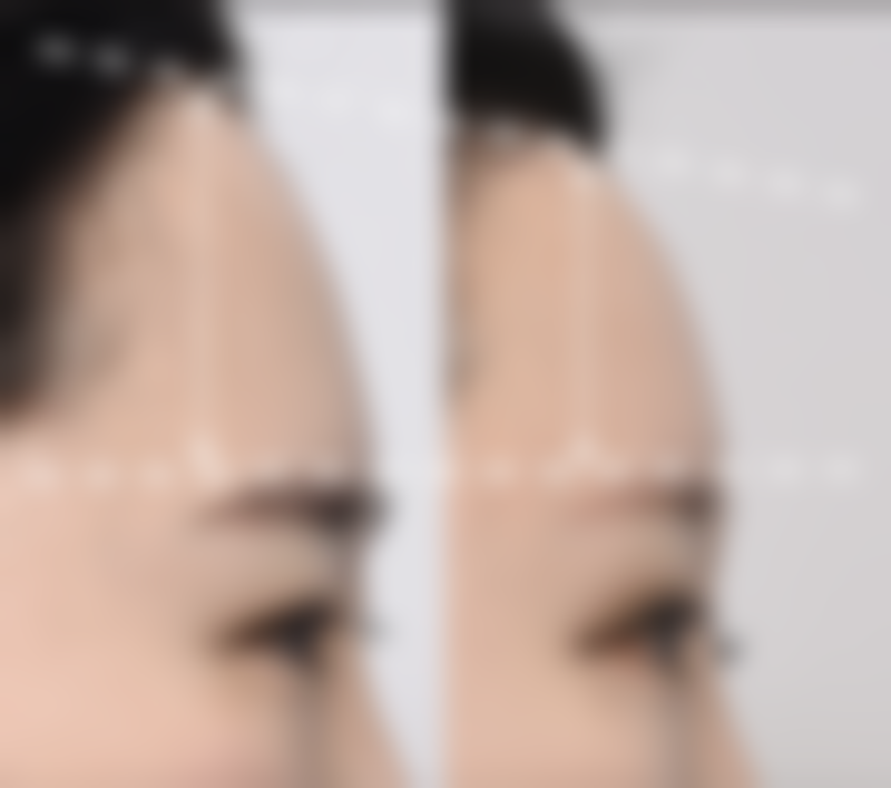 打完瘦脸针多久不会再弥散肿胀