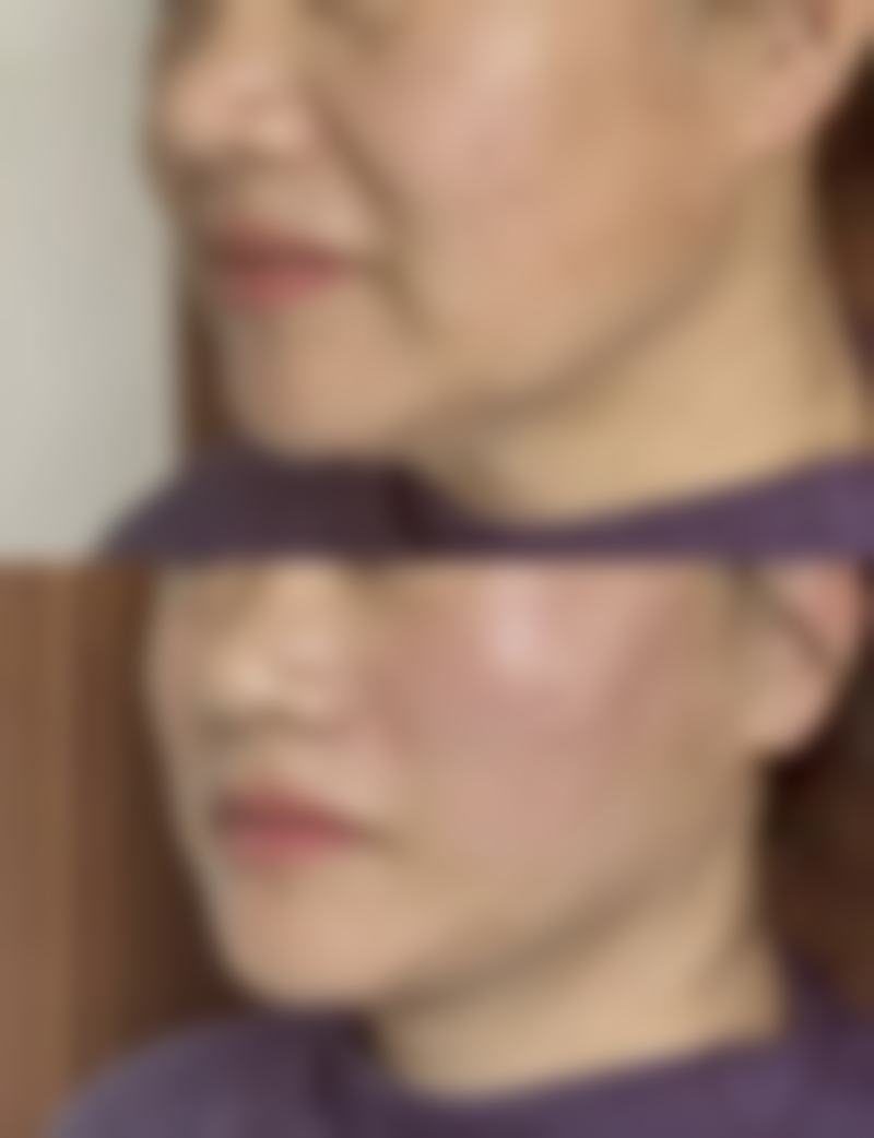 吃药可以打瘦脸针吗?
