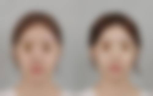 瘦脸针打完多久见效