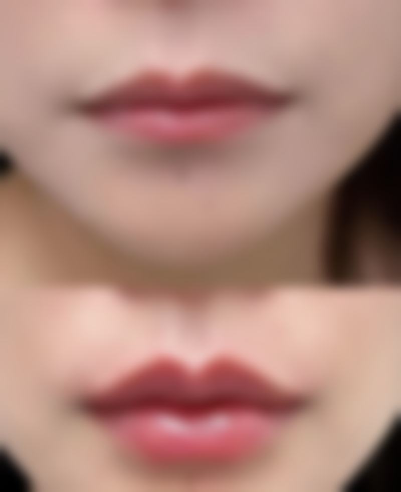 晒黑了打美白针多久能白回来
