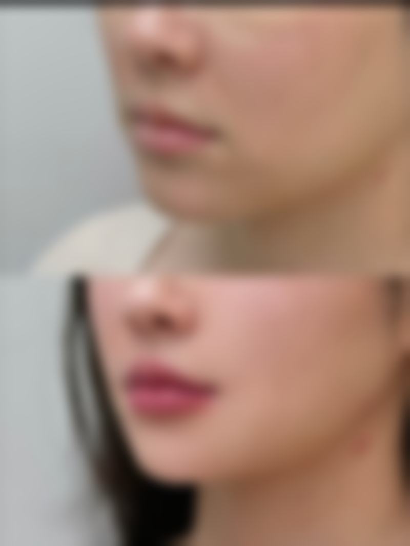 瘦脸针多久打一次成效至佳