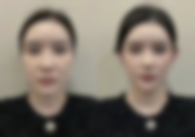 打完瘦脸针脸颊凹陷能修复到以前的样子吗