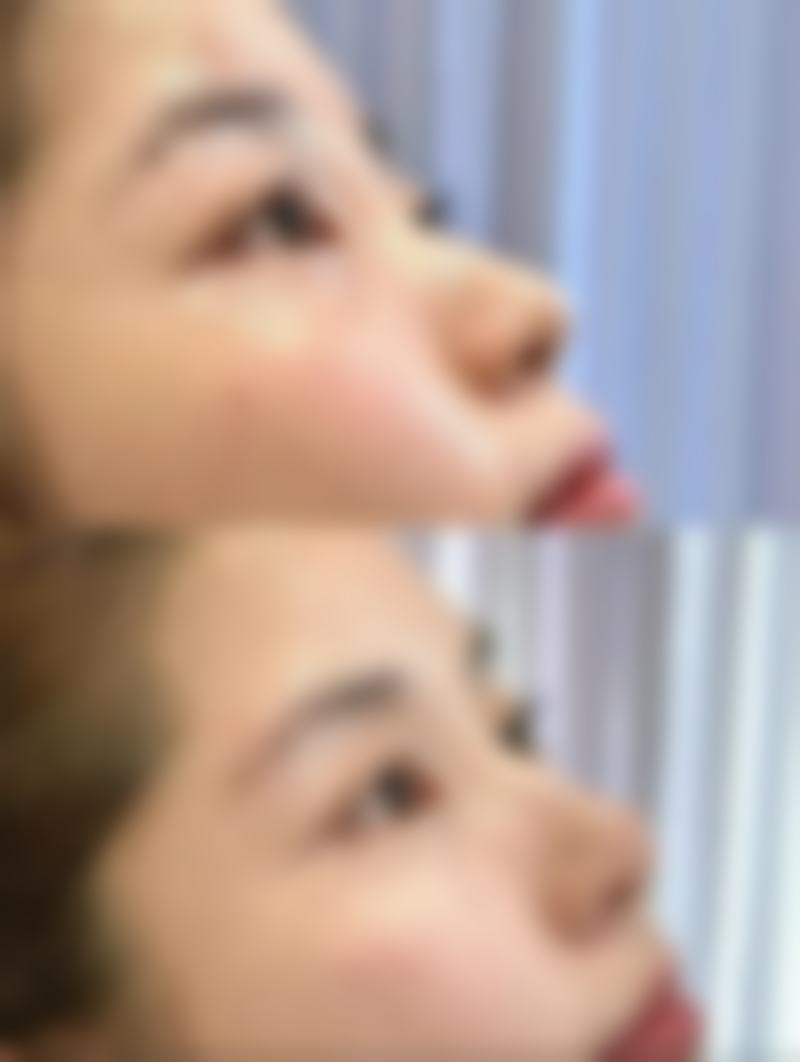 不适合打美白针人群注意事项