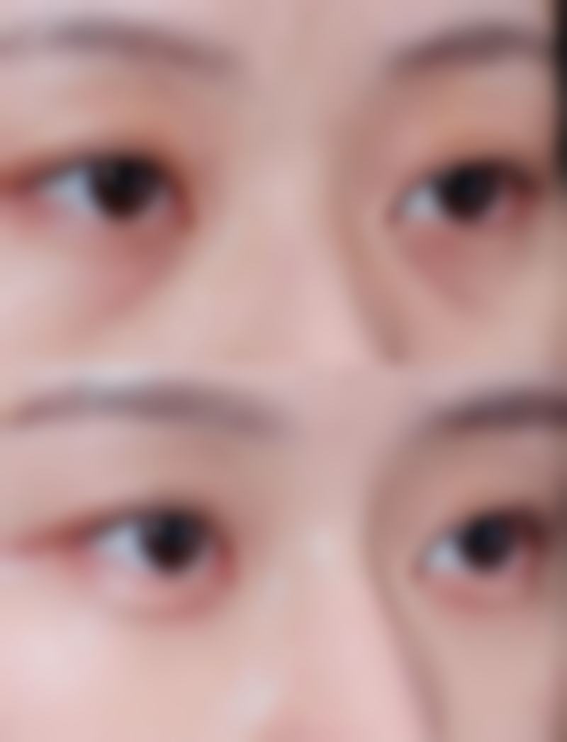 瘦脸针一针能瘦多少？揭秘一针平均可瘦 1 - 2 厘米的效果，了解瘦脸针真实成效与适用人群！ 