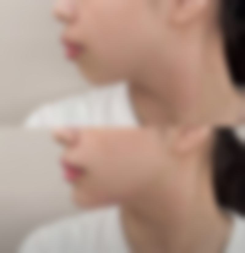 瘦脸针一针打多少毫升