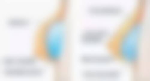 打瘦脸针去除双下巴的价格情况