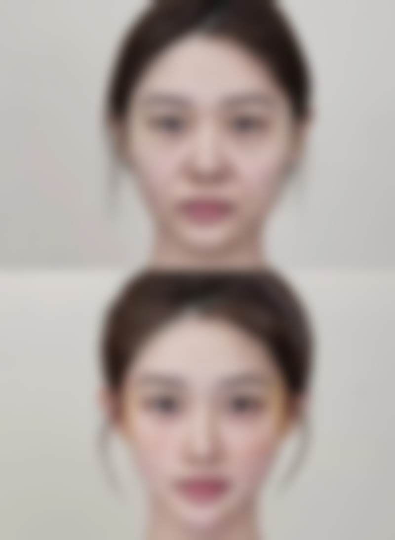 为什么打了瘦脸针 8 天还没成效?
