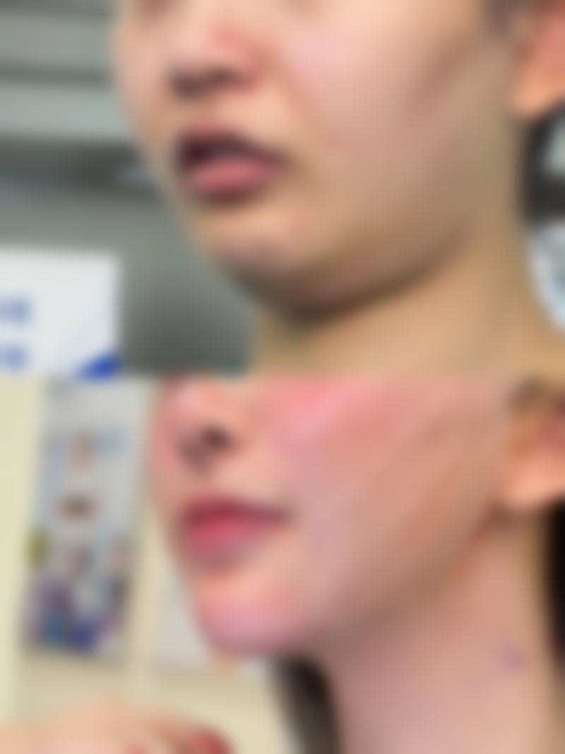 瘦脸针的价格及相关信息