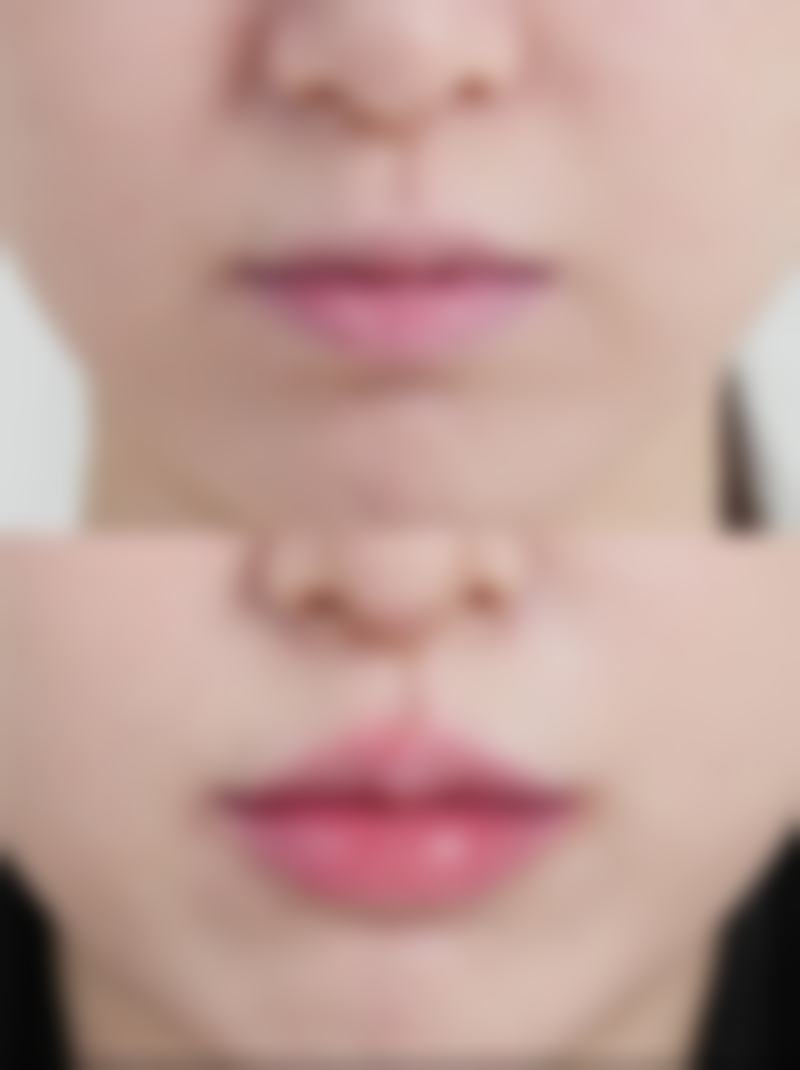 吃槟榔吃出来的咬肌可以打瘦脸针吗