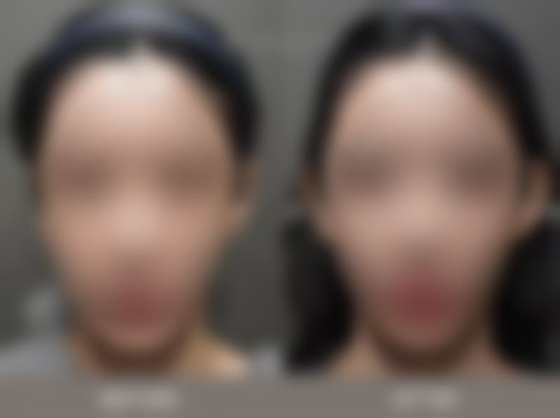 吃多了槟榔脸还可以瘦下来吗