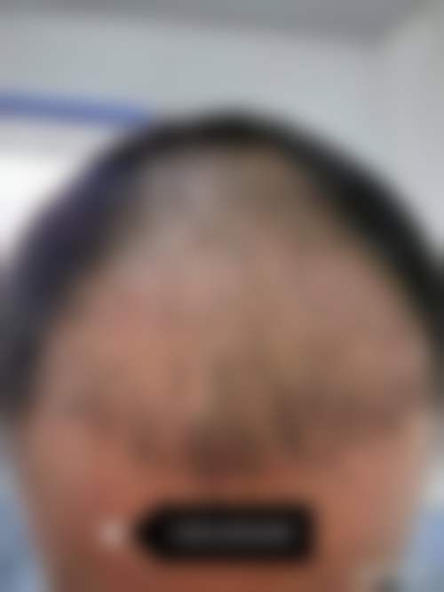 【 郑州肤康植发科是正规的吗?】
