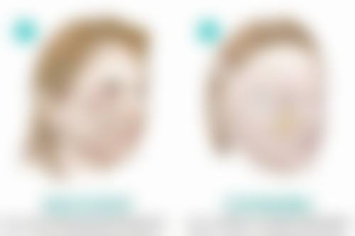 唇部整形大概多少钱