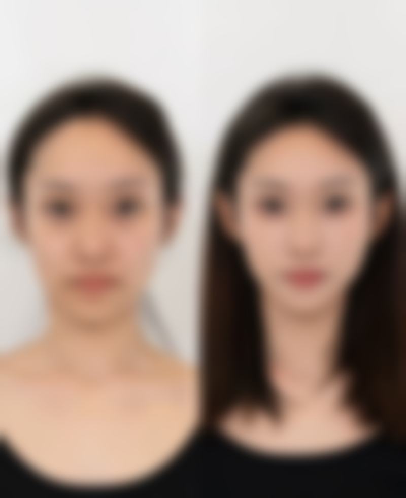 国产瘦脸针衡力成效怎么样
