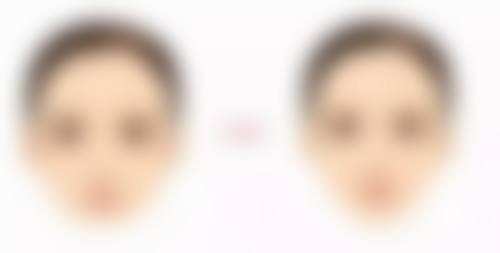 打完瘦脸多久有成效