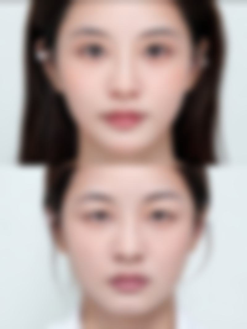 唇部整形好不好