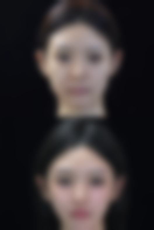 打瘦脸针可以瘦腮帮吗图片