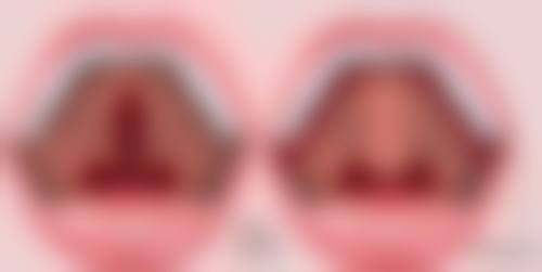 自体脂肪丰太阳穴恢复要多久？了解3大阶段恢复时间，助你快速拥有饱满太阳穴！ 