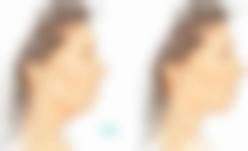 怎么样有效的除皱？揭秘医美界3大热门除皱方法，让你轻松告别皱纹，重焕青春光彩！ 