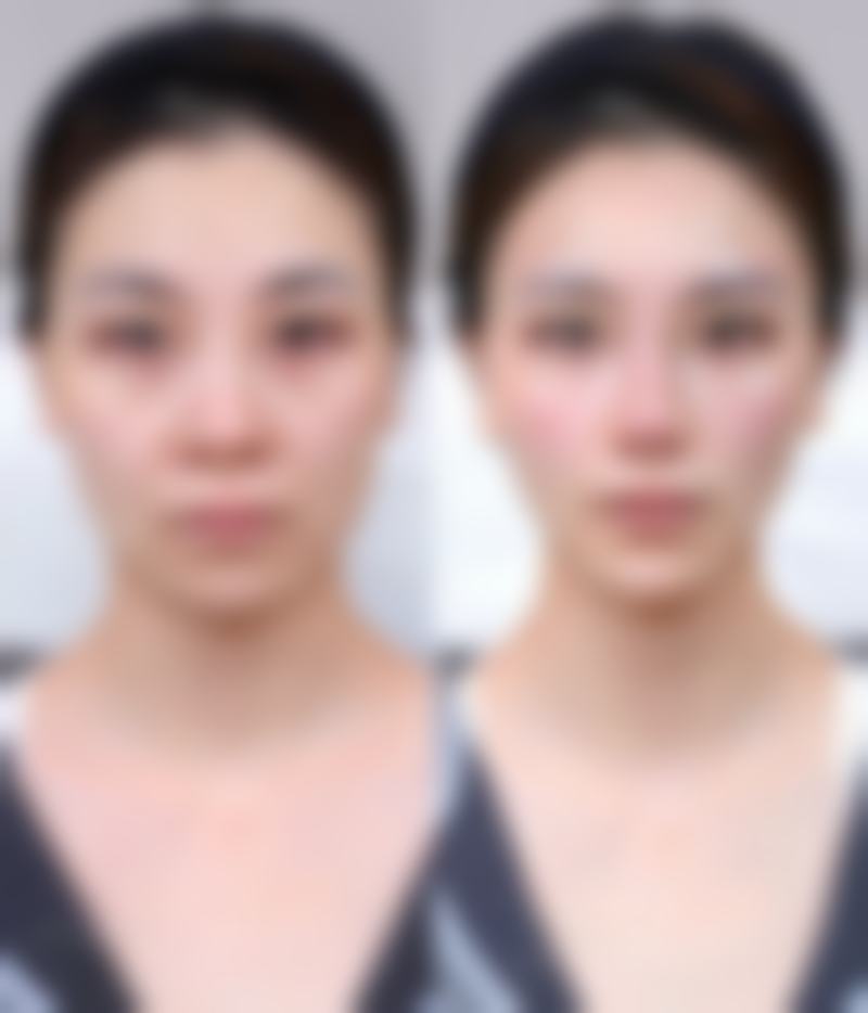 种植头发500个单位是什么意思