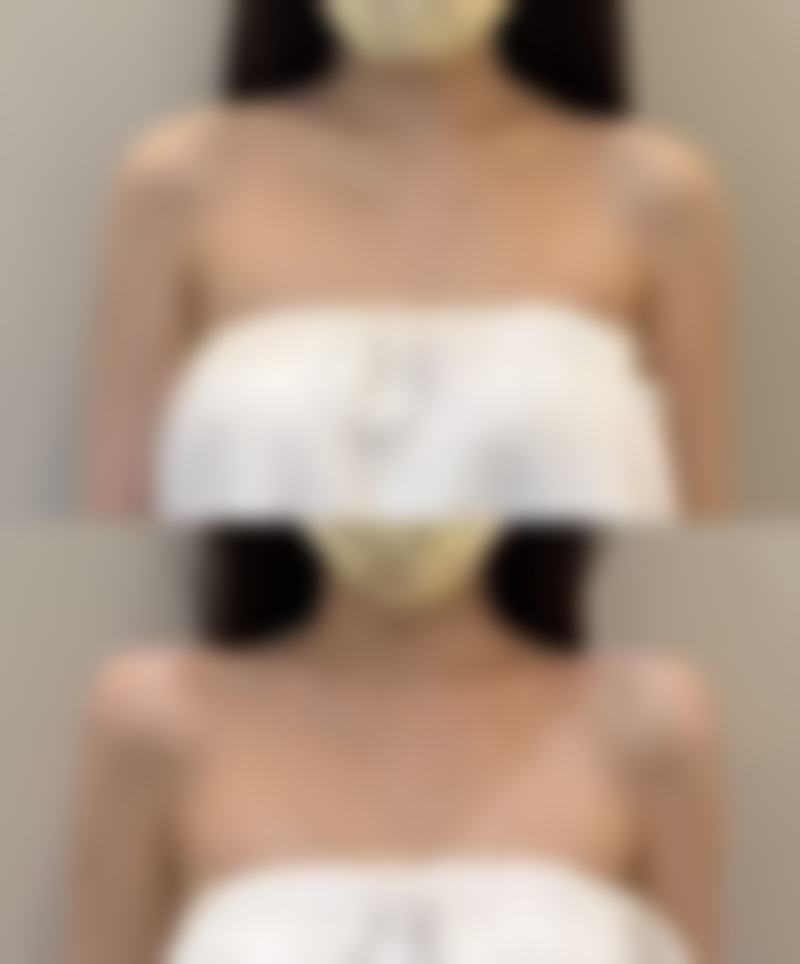 打了除皱针注意什么事项