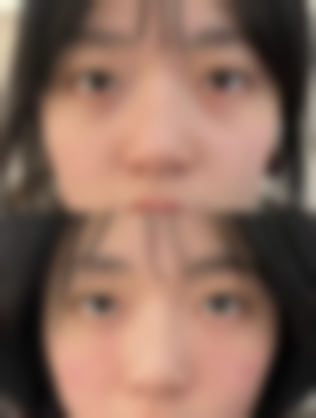 下嘴唇外翻怎么矫正