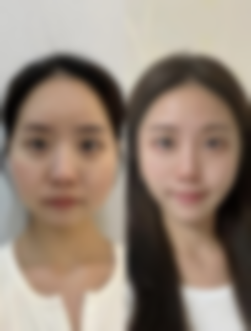 打瘦脸针