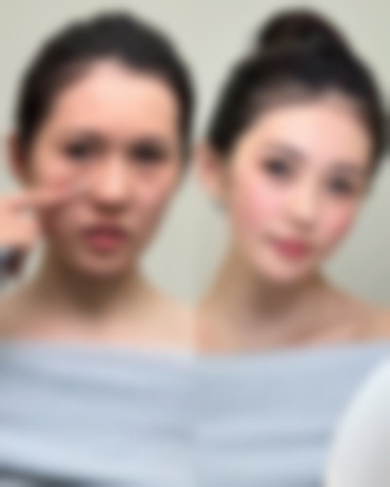 打了瘦脸针需要注意什么事项?