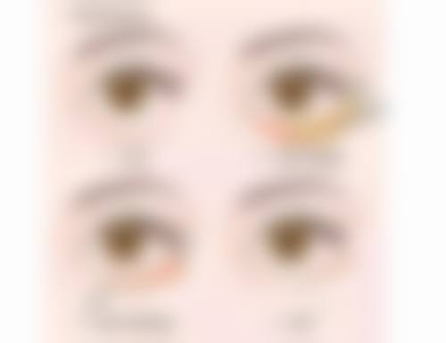 刚打完瘦脸针咬肌鼓起来多久下去？专业揭秘：最快3天缓解，正常1-2周消退的真相！ 