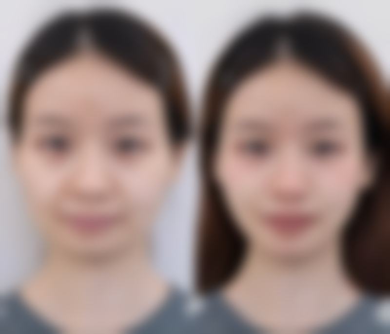下颌骨整形多久可以修复?