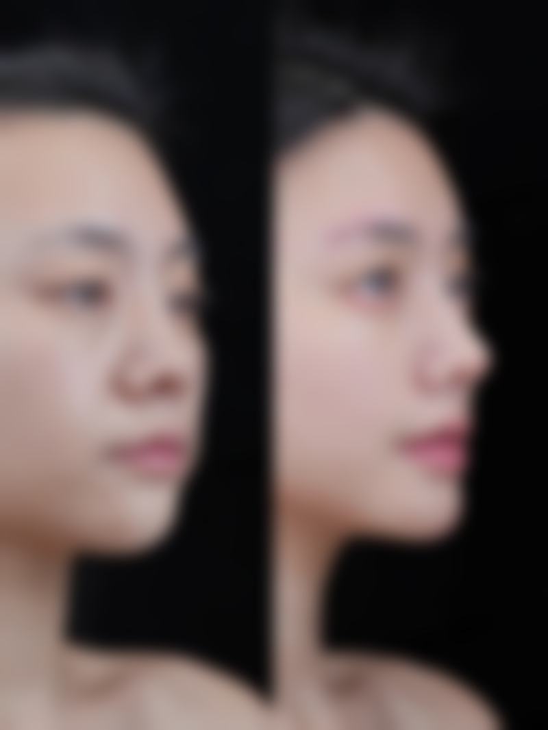 刚打完瘦脸针咬肌咬起来鼓的