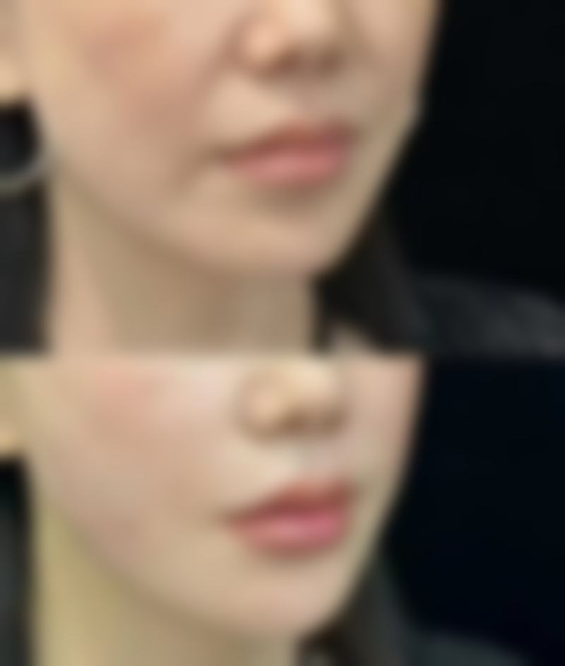 瘦脸针不适合哪些人打？这5类人群碰不得，了解禁忌才能保障医美安全与效果！ 