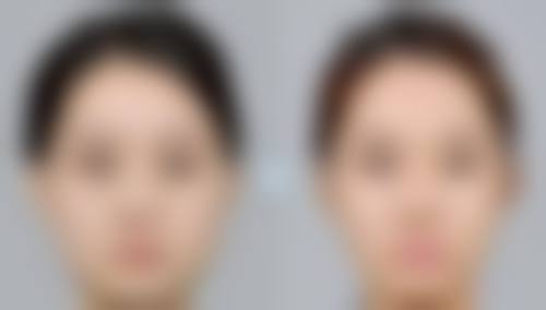 小阴唇缩小术需要多长时间